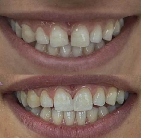 Composite Bonding in London