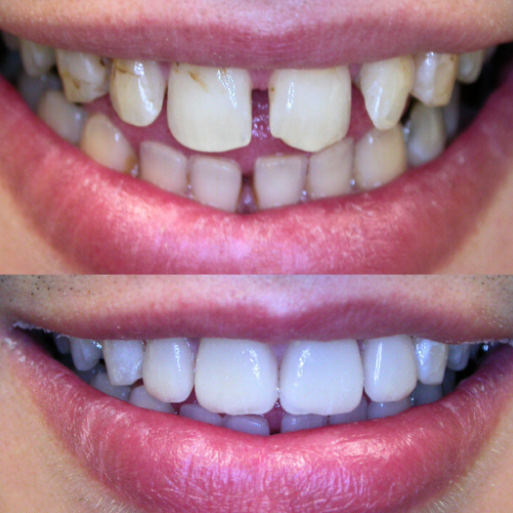 Smile Makeover near baker street