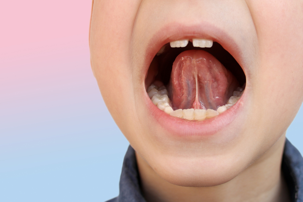 a close up image of a young children lifting his tongue to show a tongue tie