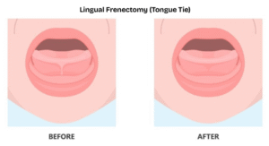 a diagram showing a tongue tie of a child