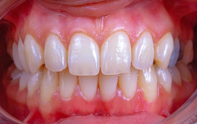 what are the signs of gum disease